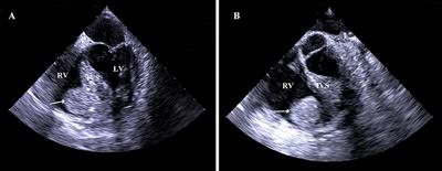 Case Report: A Primary Right Ventricular Vascular Malformation Presenting as a Mass